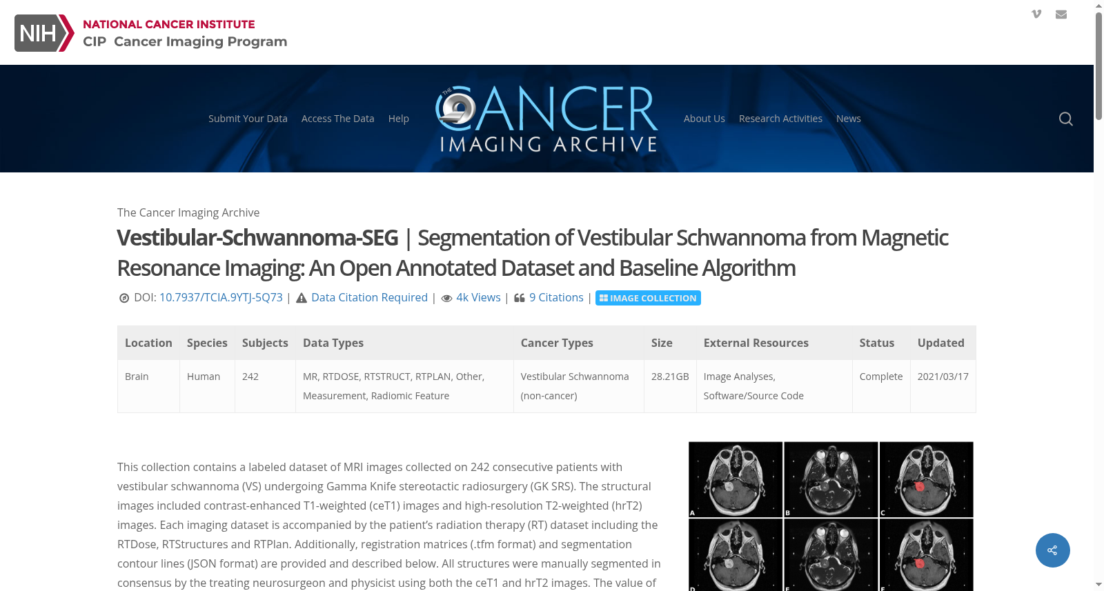前庭神经鞘瘤磁共振成像分割数据集(Vestibular-Schwannoma-SEG)